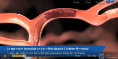 Capture écran video thrombectomie 20minutes.fr, jpg